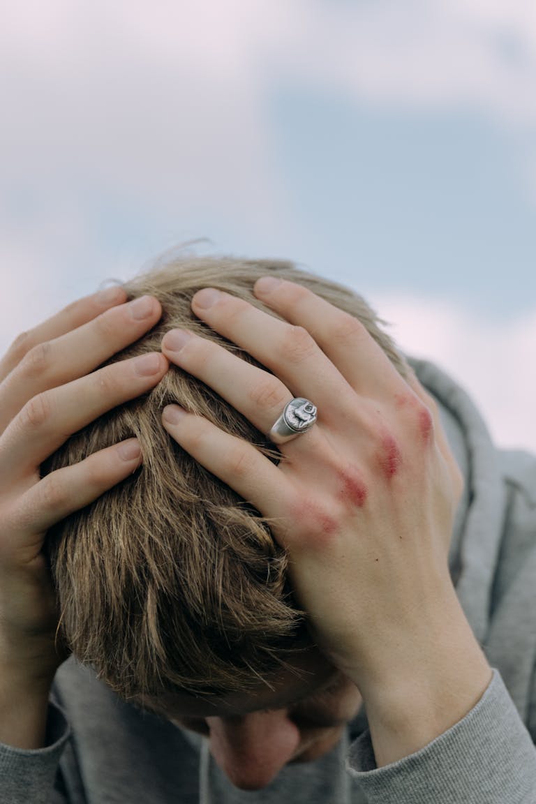 Close-up of a person with a bruised hand holding head outdoors, showing stress or headache.